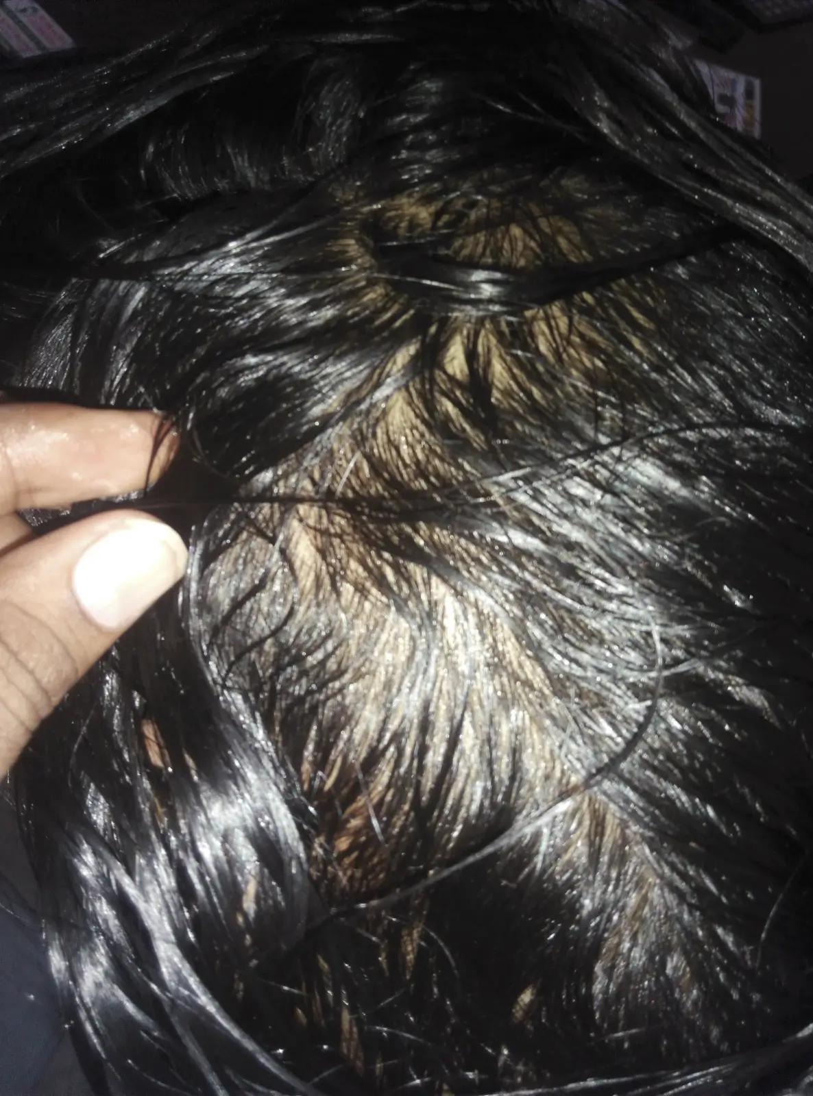 Alopecia Areata case 5 after treatment